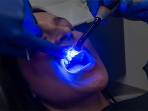5 consejos si estás pensando en realizarte un blanqueamiento dental