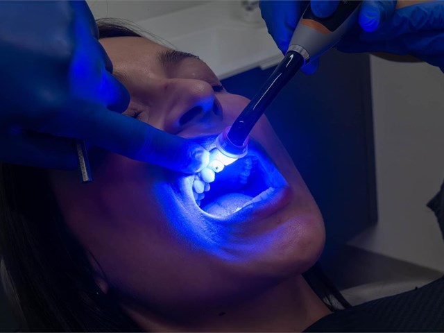 5 consejos si estás pensando en realizarte un blanqueamiento dental