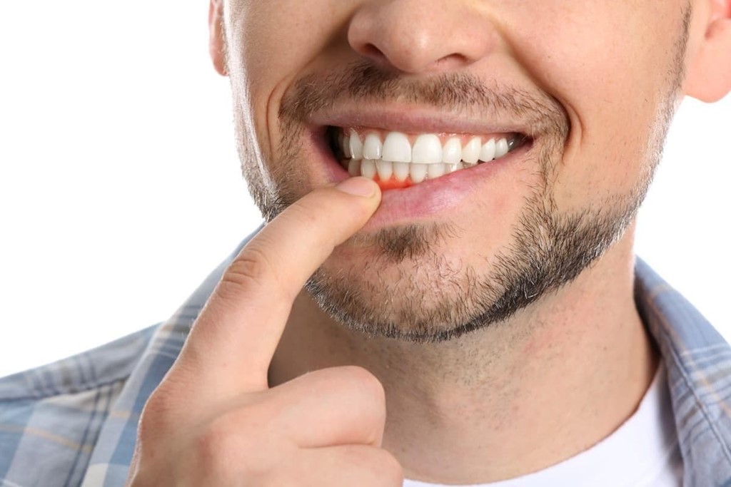 ¿Cuáles son las enfermedades periodontales? 