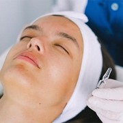 ¿Qué es el peeling químico y cuáles son sus beneficios?